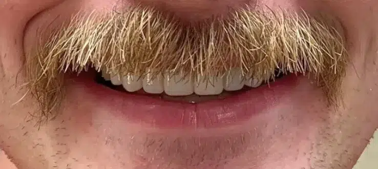 Close-up of smiling man with thick mustache showing upper teeth.