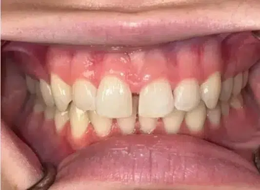 Close-up of open mouth showing misaligned and discolored natural teeth.