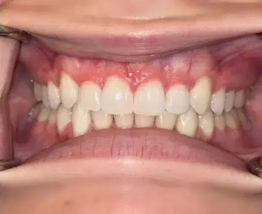 Close-up of open mouth showing misaligned and discolored natural teeth