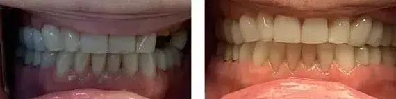 Side-by-side comparison showing teeth alignment before and after treatment