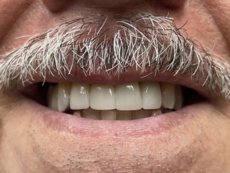 Close-up of smiling man with white mustache and artificial teeth