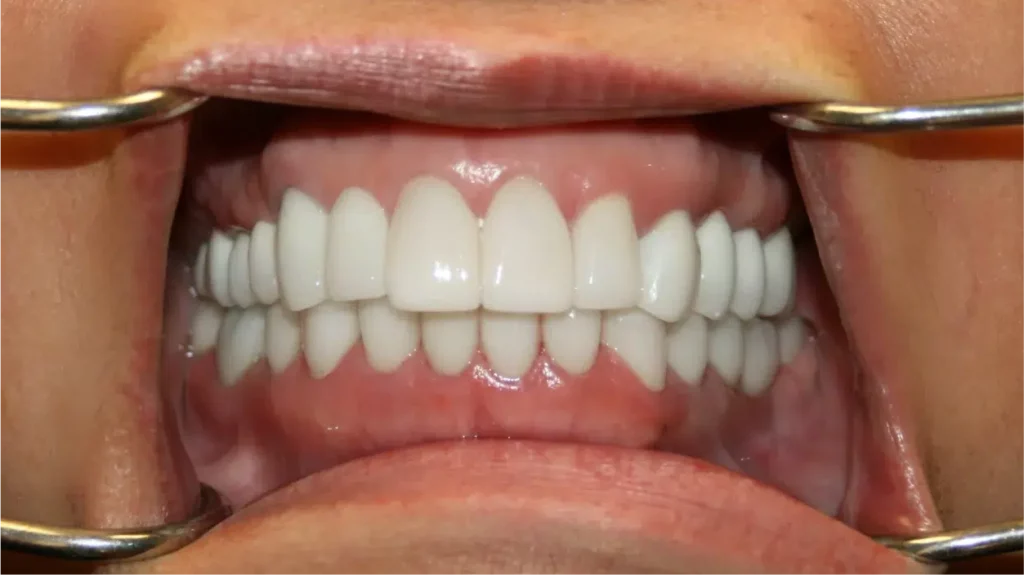 Close-up of open mouth showing perfectly aligned white dental veneers