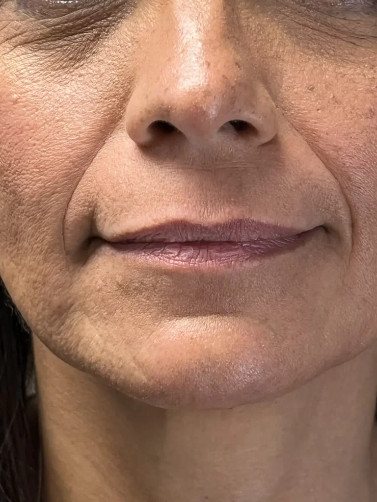 Close-up of woman’s mouth showing asymmetry and mild lip swelling