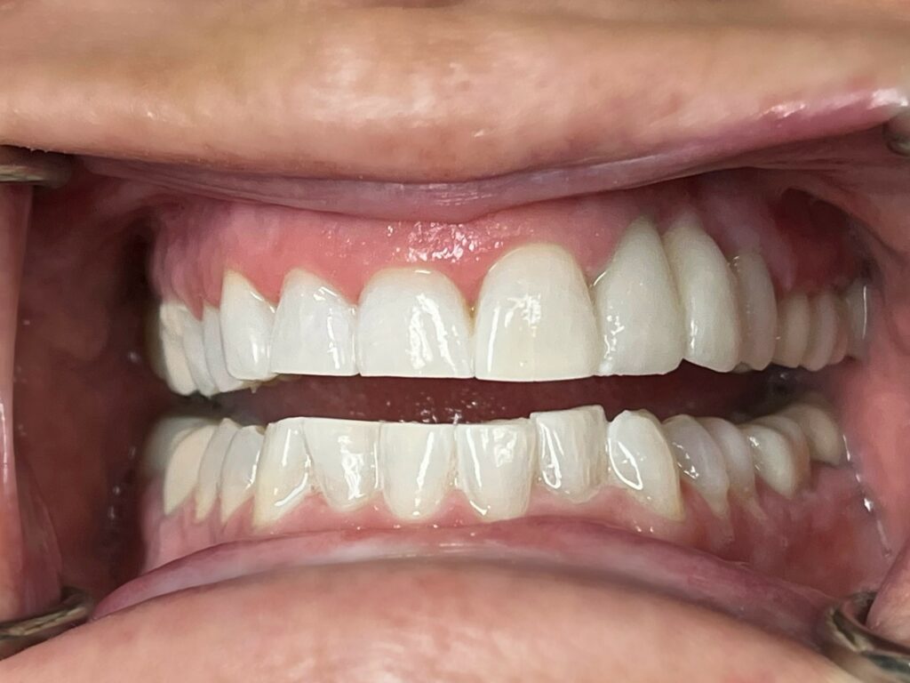 Close-up of open mouth showing clean white teeth and gums