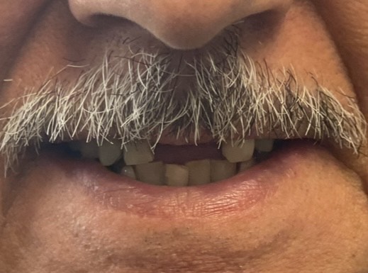 Close-up of man’s mouth with gray mustache and missing teeth.