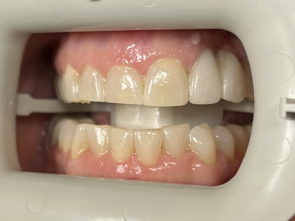 Close-up of open mouth showing teeth alignment and dental shade guide